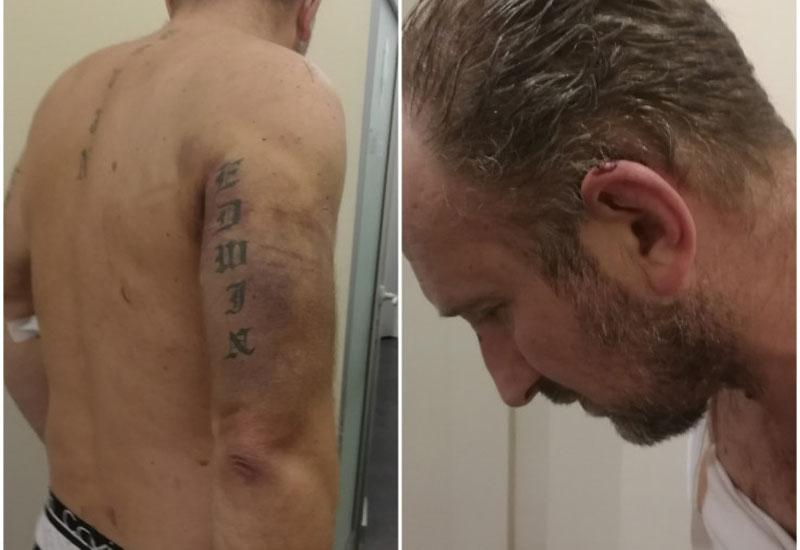 Enes Džinović tvrdi da je žrtva policijske brutalnosti: “12 ljudi me tuklo palicama i nogama”