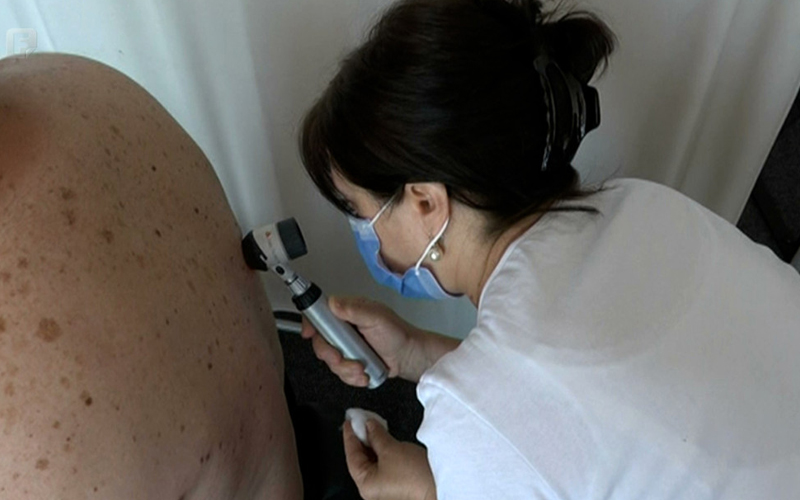 Bosna i Hercegovina nema registar oboljelih od melanoma kože